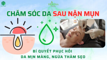 Chăm sóc da sau nặn mụn giúp ngừa thâm sẹo và phục hồi da mịn màng