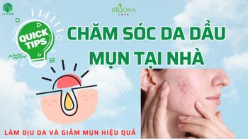Chăm sóc da dầu mụn tại nhà giúp giảm mụn và làm dịu da hiệu quả